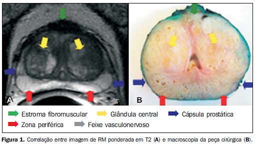 Ressonância magnética da próstata: uma visão geral para o radiologista