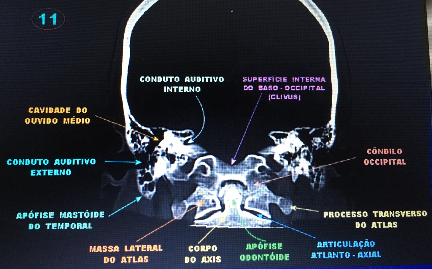 Exames de imagem em otorrinolaringologia de uma Tomografia computadorizada de mastoide em corte coronal, com enfoque na visualização do sistema auditivo.