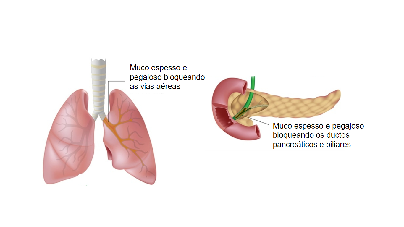 Fibrose Cística O Que é Epidemiologia E Mais Sanar Medicina