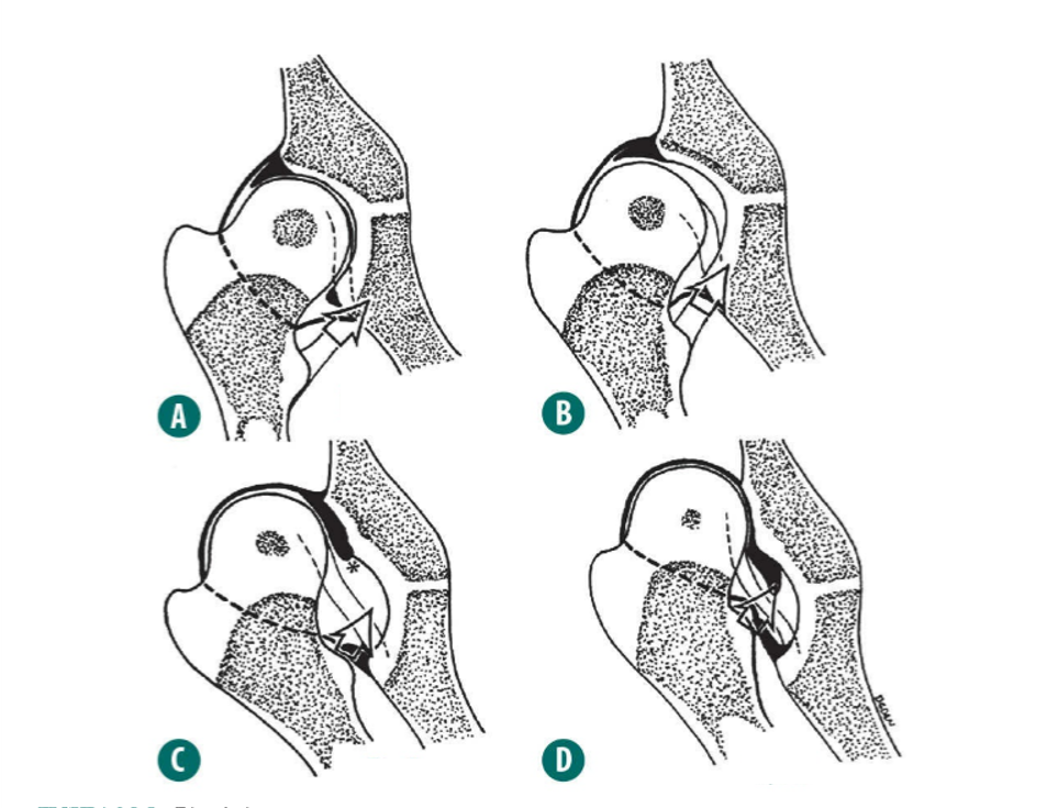 Grau de deslocamento da cabeça femoral. A. Quadril normal; B. Quadril displásico; C. Quadril displásico com subluxação ou luxação; D. Quadril com luxação.
