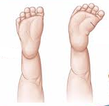 Diferença entre pé normal e pé com metatarso aduto. À esquerda, pé normal. À direita, pé com metatarso aduto.
